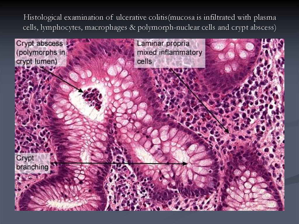 Histological examination of ulcerative colitis(mucosa is infiltrated with plasma cells, lymphocytes, macrophages & polymorph-nuclear cells and crypt abscess)