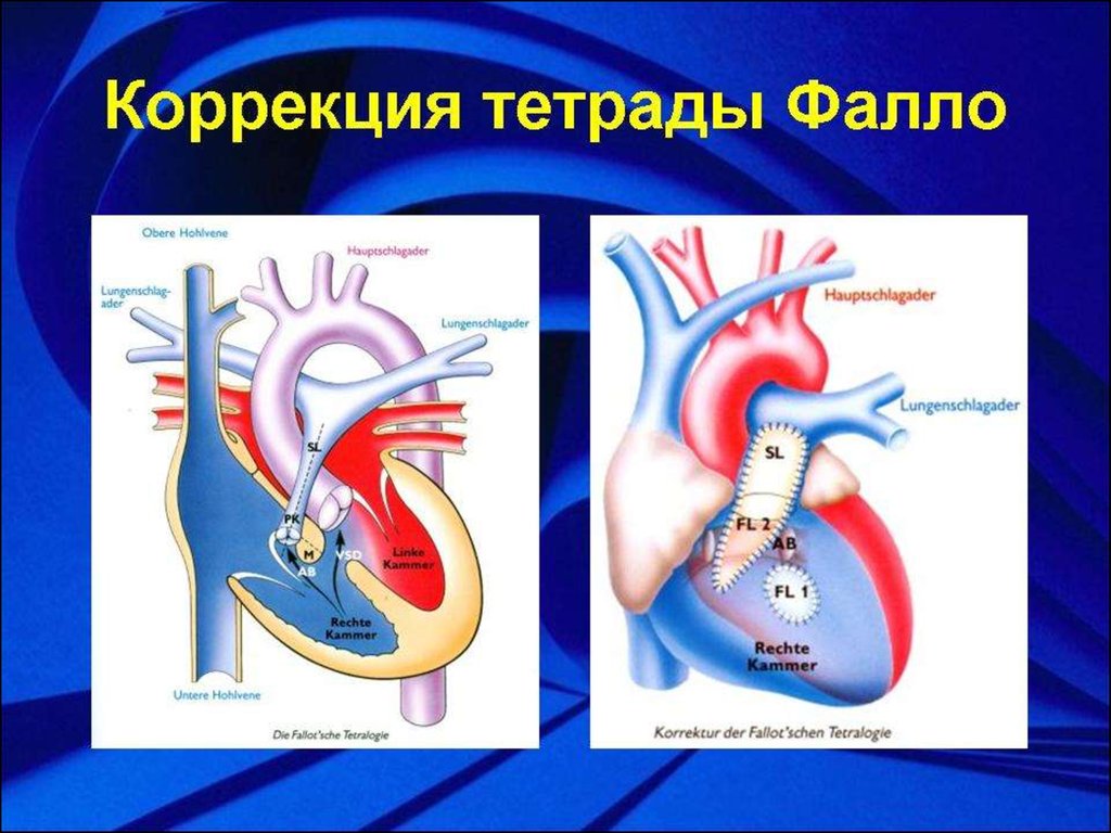 Тетрада фалло лечение