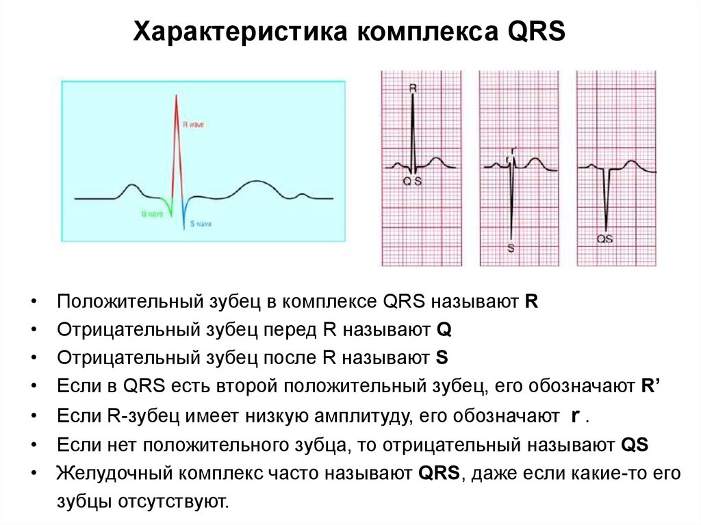 Qrs на экг что это. Отрицательный комплекс QRS на ЭКГ. Отрицательный зубец р после QRS комплекса. Отрицательный QRS во 2 отведении. Отрицательный комплекс QRS во 2 отведении.