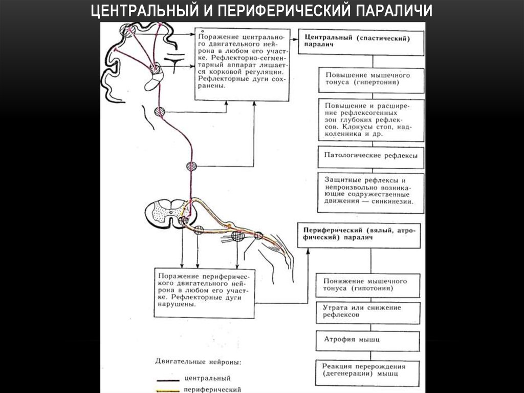 Параличи этиология. Признаки поражения центрального двигательного нейрона. Патогенез центрального и периферического паралича. Гемиплегия патогенез. Поражение двигательного анализатора схема.