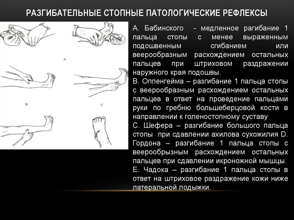 Рефлексы равновесия. Патологические рефлексы Бабинского Россолимо Гордона. Рефлексы Бабинского Оппенгейма Гордона Шеффера Россолимо Жуковского. Рефлекс Бабинского Оппенгейма Гордона. Рефлексы (Оппенгейма, Шеффера, Бабинского, Россолимо, Гордона.