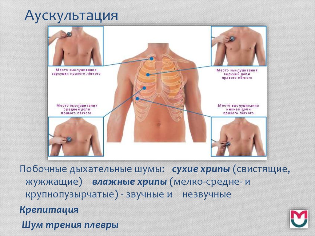 Хрипы в груди. Точки аускультации лёгких алгоритм. Точки аускультации лёгких спереди. Методика аускультации легких. Точки выслушивания легких при аускультации.