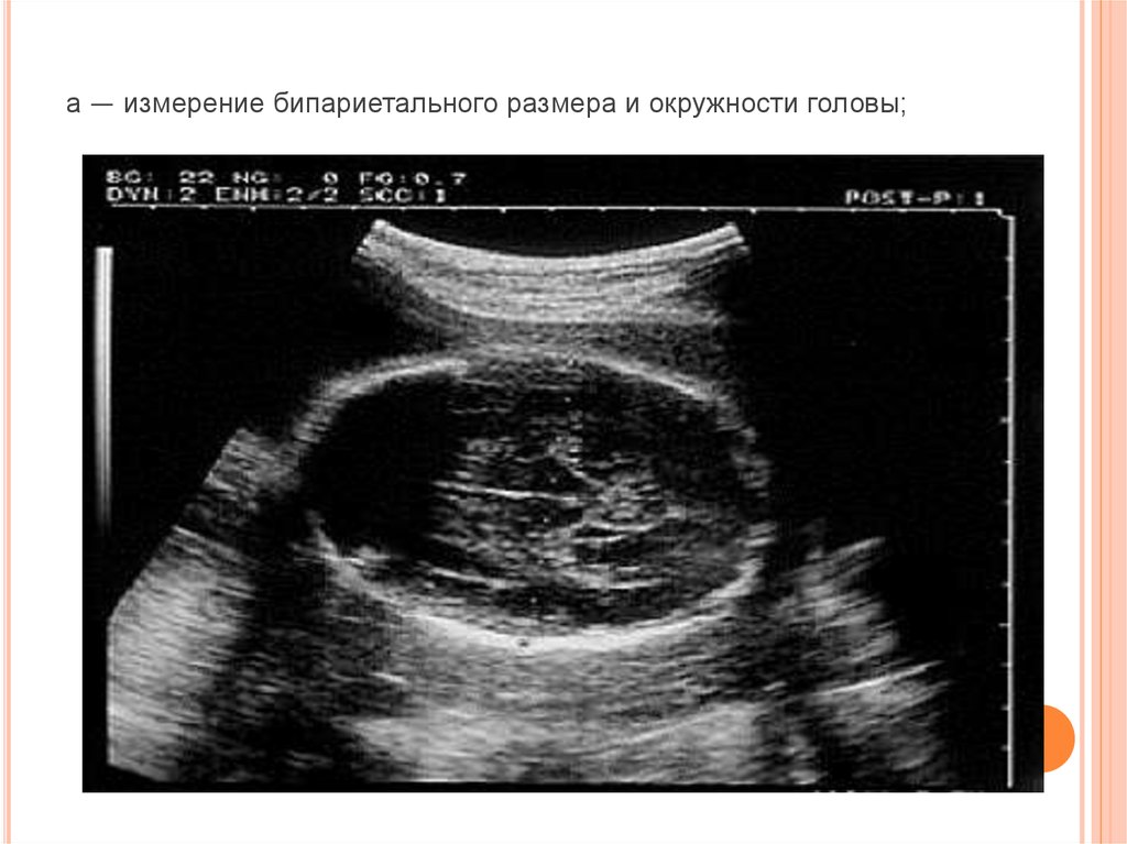 Бпр на узи при беременности. Измерение бипариетального размера головки плода. Бипариетальный размер головы. Бипариетальный размер головки.