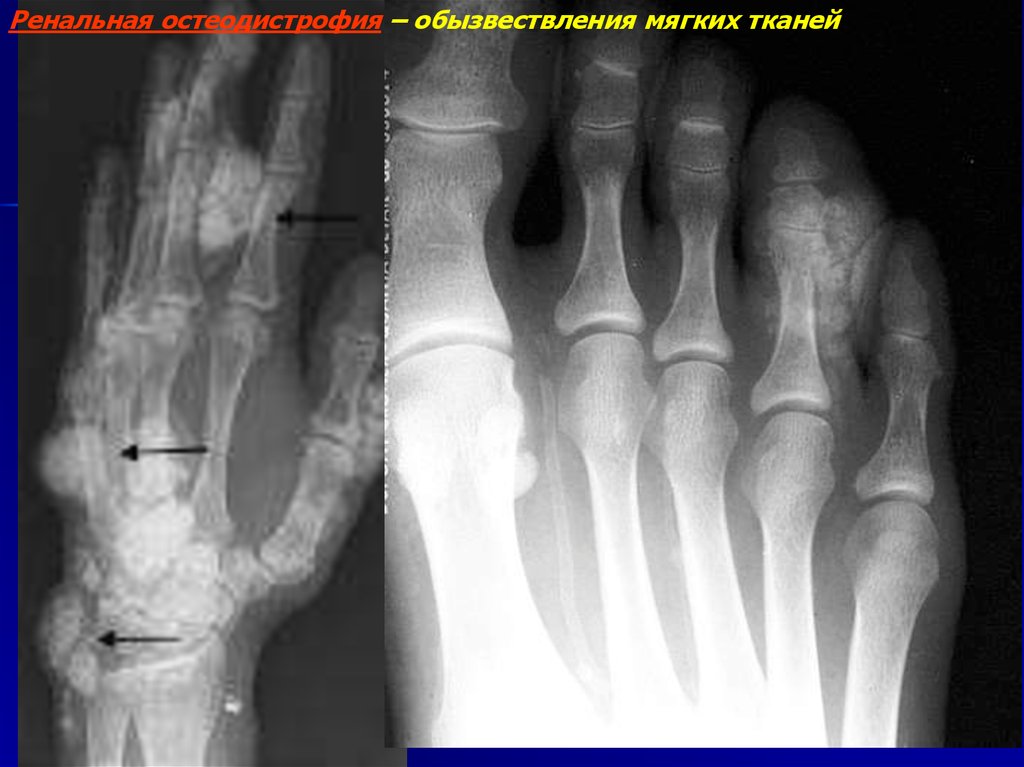 Дистрофические изменения костей. Обызвествление костей рентген. Обызвествление мягких тканей рентген. Обызвествления в мягких тканях голени.