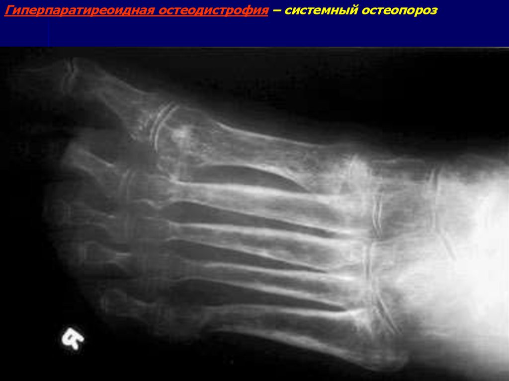 Остеопороз стопы. Пятнистый остеопороз Зудека. Гиперпаратиреоидная остеодистрофия рентгенодиагностика. Синдром Зудека рентген.