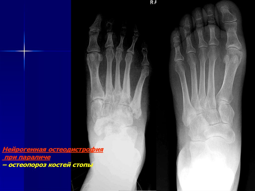 Остеопороз стопы. Остеопороз плюсневой кости рентген. Остеопороз плюсневой кости стопы. Остеомиелит головки плюсневой кости. Остеопороз костей стопы рентген.