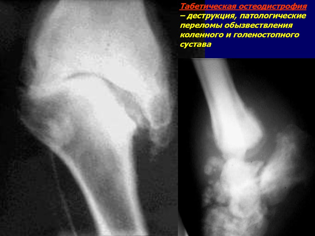 Патологический перелом. Обызвествление связок коленного сустава на рентгене. Болезнь Пеллегрини-Штида коленного сустава. Голеностопный сустав обызвествления. Обызвествления в коленном суставе на рентгене.