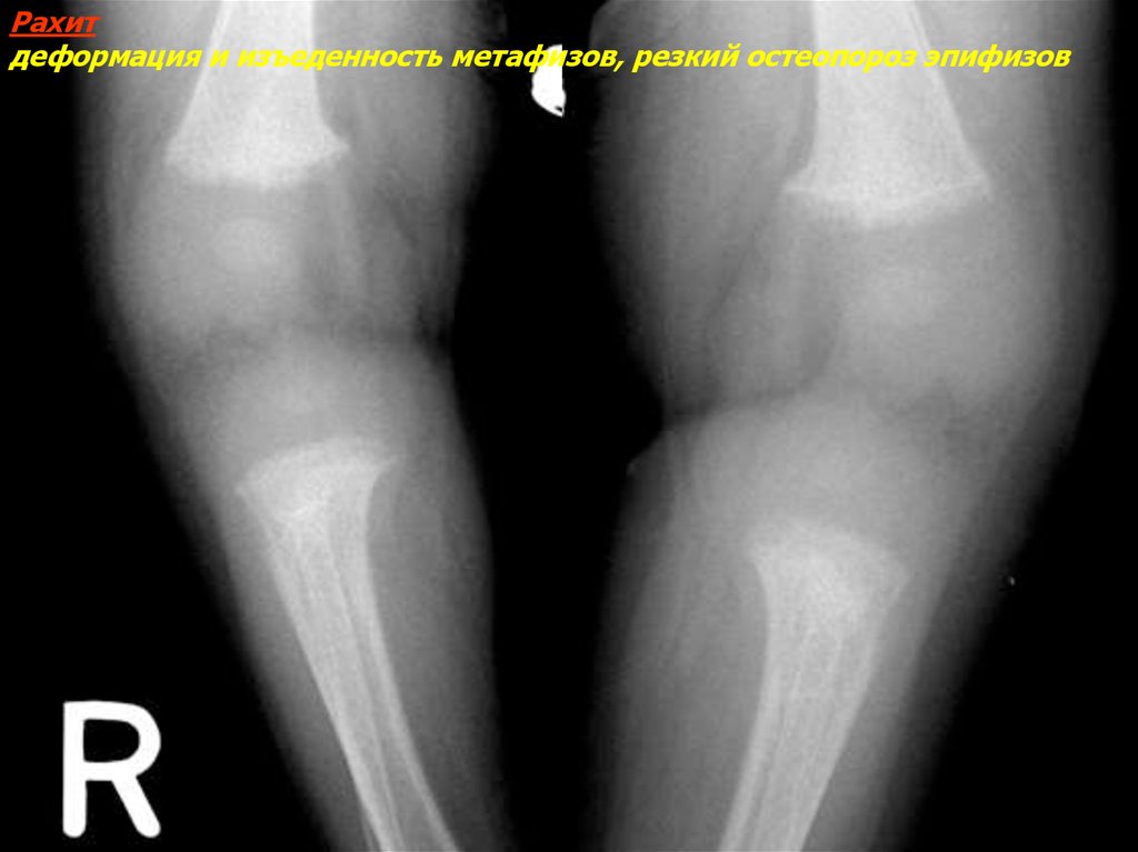 Деформация костей. Рахит 2 степени рентген.