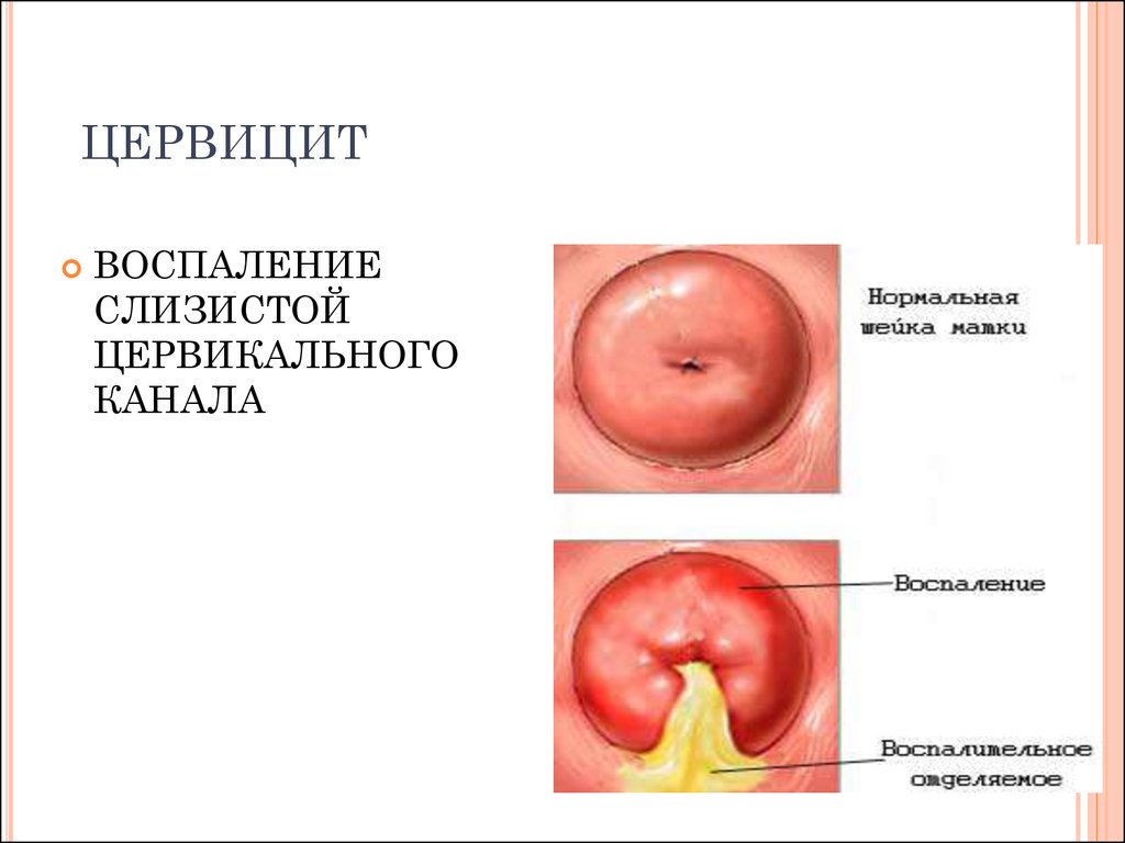 цервицит при Mycoplasma genitalium