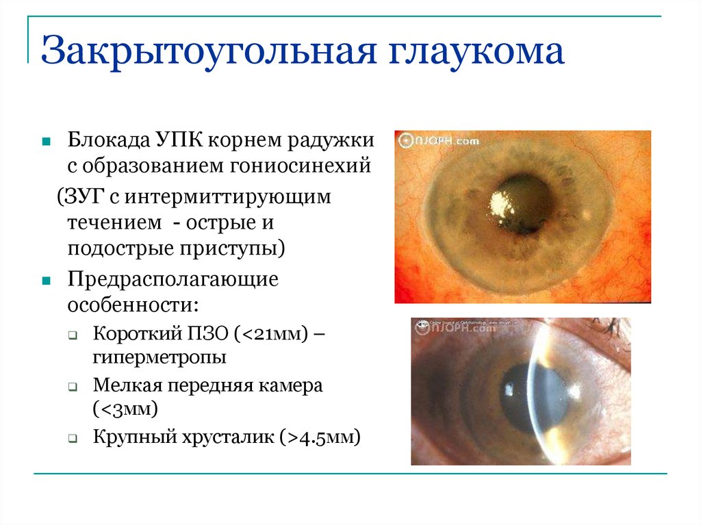 Открытоугольная глаукома клинические рекомендации. Острый приступ закрытоугольной глаукомы. Первичная открытоугольная глаукома симптомы. Причины закрытоугольной глаукомы. Формы первичной закрытоугольной глаукомы.