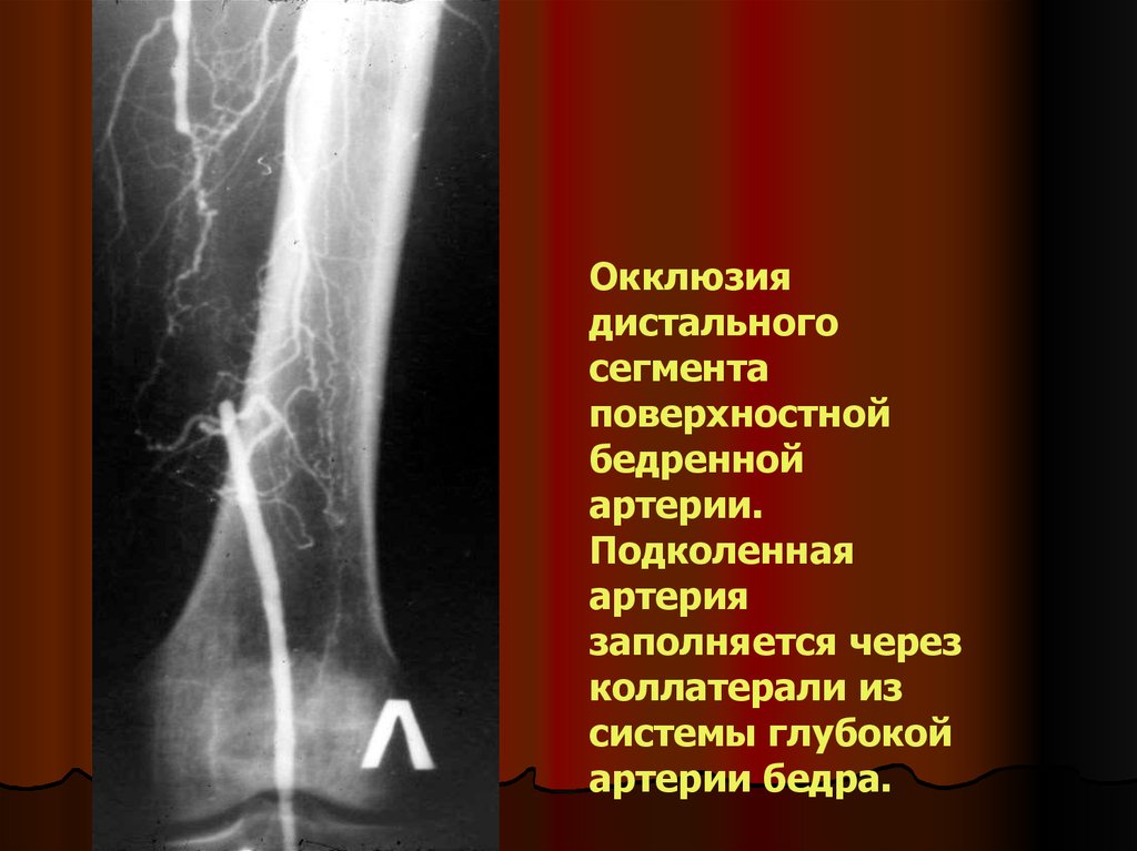 Бедренно подколенное окклюзии. Окклюзия бедренной артерии. Поверхностная бедренная артерия окклюзия. Окклюзия берцовых артерий. Окклюзия периферических артерий что это.