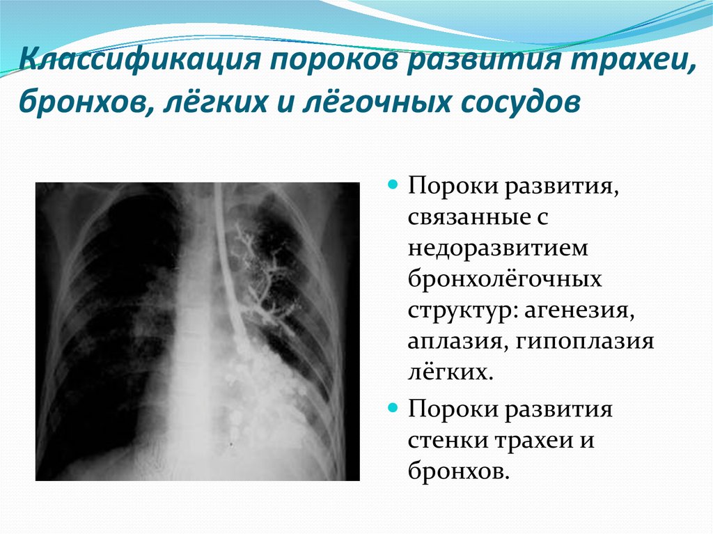 Развитие легких. Пороки развития легких классификация. Пороки развития трахеи и бронхов. Врожденная патология легких.