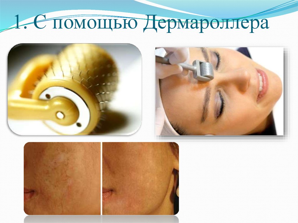 1. С помощью Дермароллера