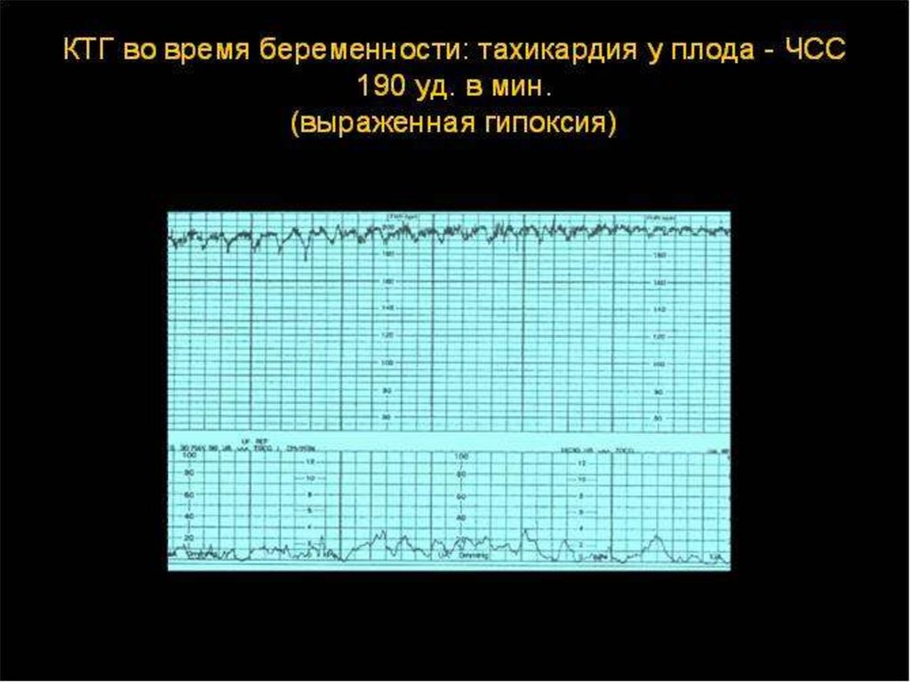 Ктг плода при беременности. КТГ при тахикардия у плода. Нормальный Тип Кривой КТГ. Учащённое сердцебиение при беременности у плода. Учащенное сердцебиение у плода на КТГ.