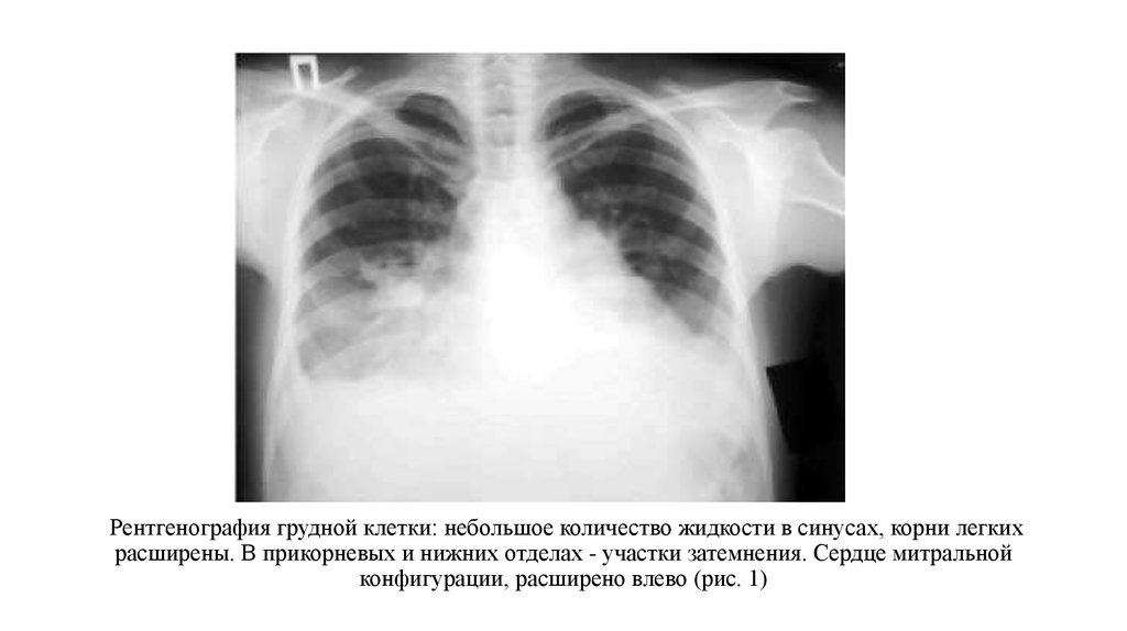 Синусы легких свободны. Рентген грудной клетки расшифровка снимков. Рентген органов грудной клетки пневмония. Рентгенография грудной клетки патология. Рентген грудной клетки пневмония.