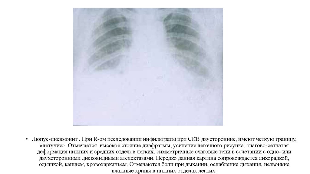 Деформация легочного рисунка по мелкоячеистому типу