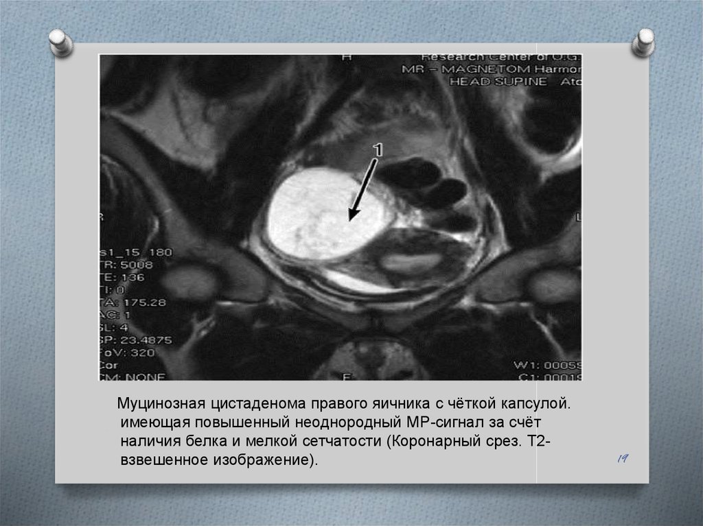 Неоднородные яичники. Серозная цистаденофиброма гистология. Серозная цистаденома мрт. Многокамерная муцинозная кистома яичника. Цистаденокарцинома яичника мрт.