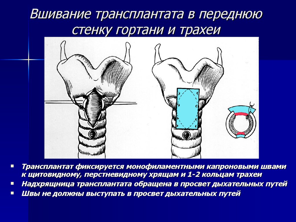 Болезни гортани фото и симптомы