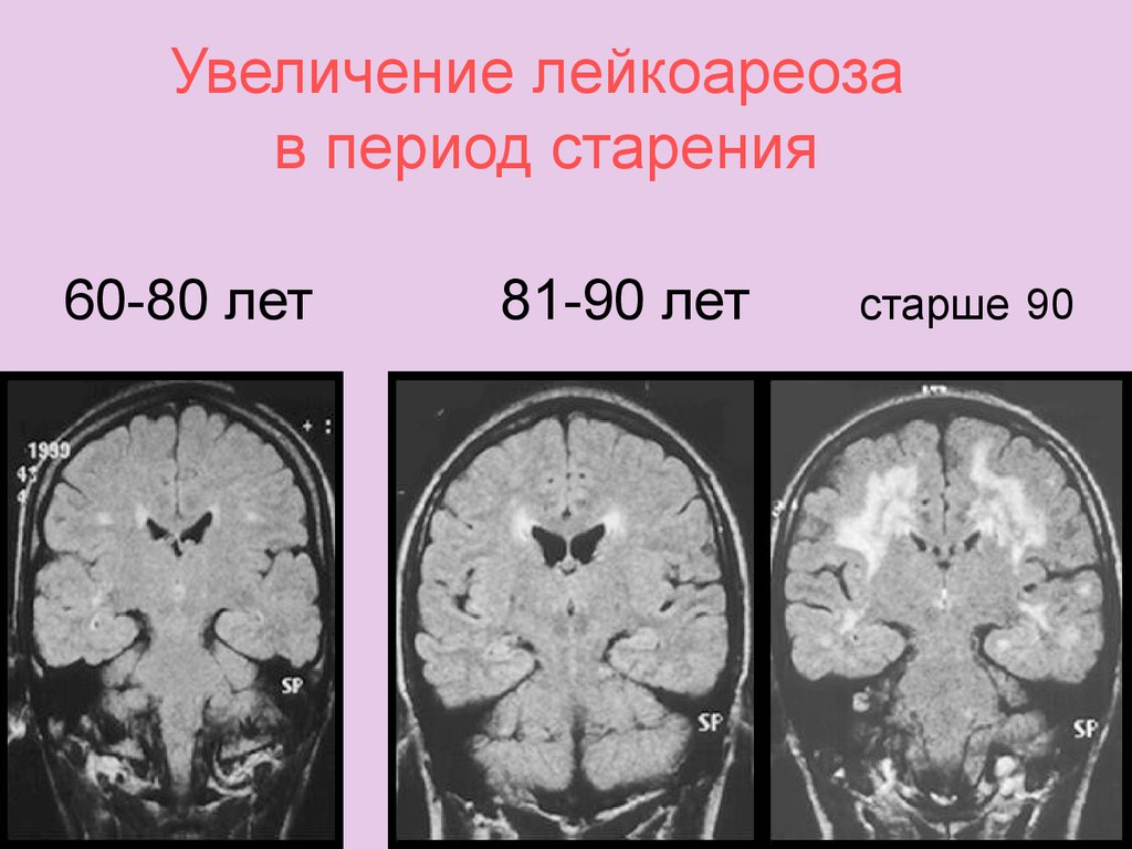 Лейкоареоз мозга. Перивентрикулярный лейкоареоз мрт. Лейкоареоз головного мозга кт. Лейкоареоз на кт. Зона лейкоареоза в головном.