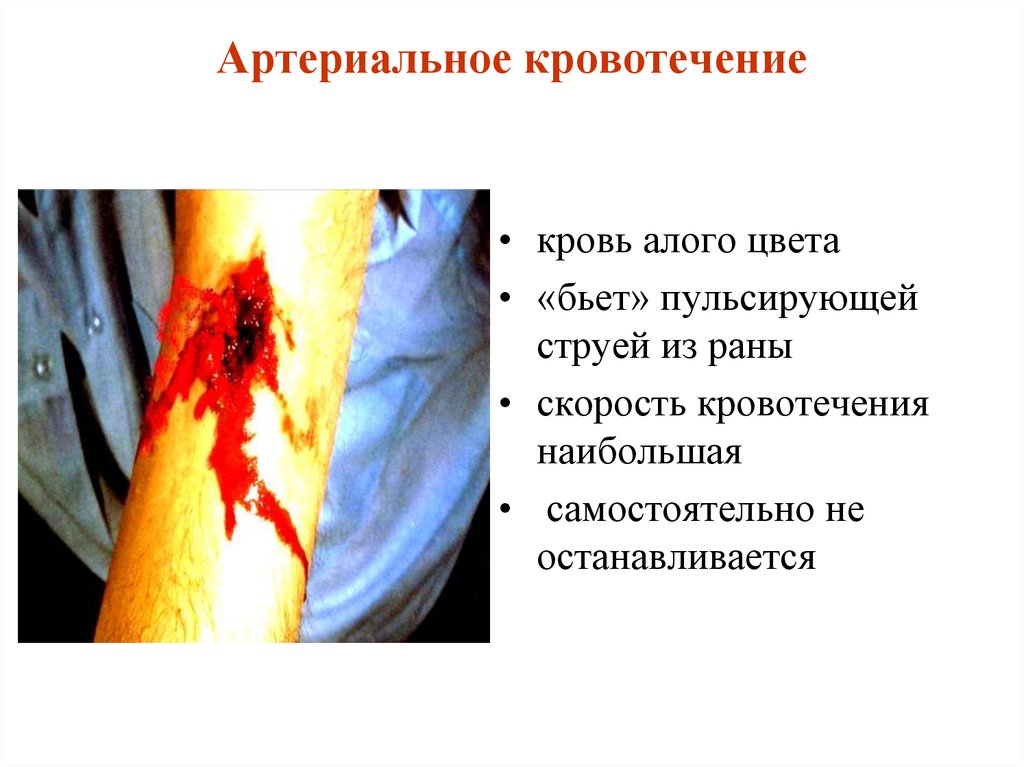 Артериальное кровотечение