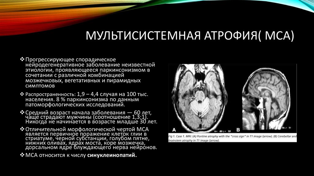 Диффузная атрофия головного. Мультисистемная атрофия клинические рекомендации. Мультисистемная атрофия головного мозга. Мрт при мультисистемной атрофии. Мультисистемная атрофия головного мозга на мрт.