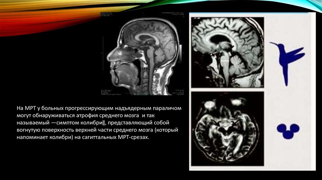 Атрофия мозга симптомы. Атрофия среднего мозга мрт. Прогрессирующий надъядерный паралич. Прогрессивный надъядерный паралич мрт. Симптом Колибри на мрт.