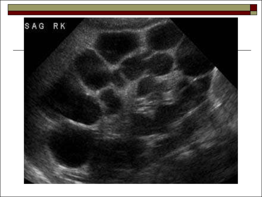 Поликистоз инфильтративного типа мелкокистозного типа дает эхографическую картину