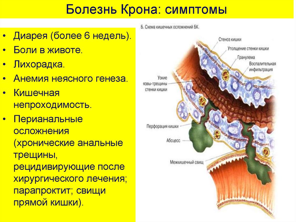 Болезнь крона лечение у взрослых кишечника. Симптомы брлезникрона. Болезни кротона.