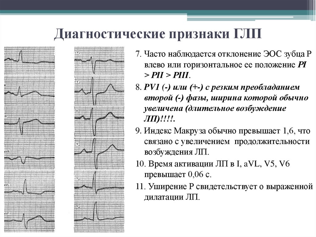 Отклонение эос влево. Признаки ГЛП на ЭКГ. Электрическая ось предсердий. Признаки ГЛП.