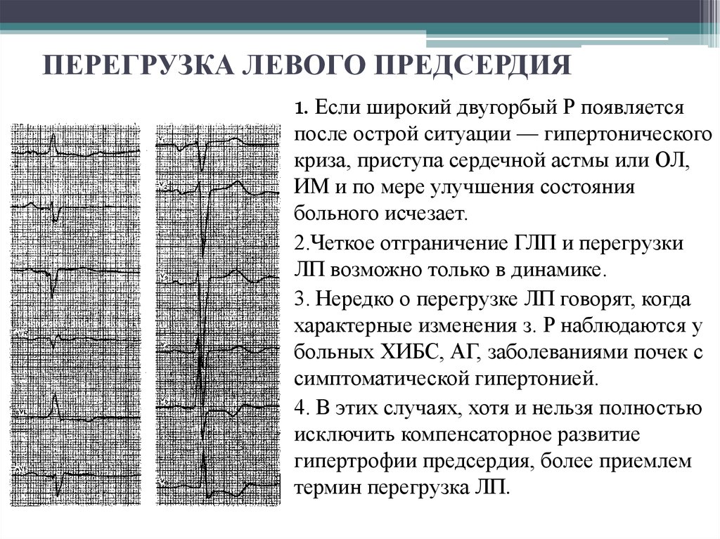 Перегрузка на экг что это. Гипертрофия левого предсердия на ЭКГ. Гипертрофия правого предсердия на ЭКГ. Признаки перегрузки предсердий на ЭКГ. Гипертрофия правого предсердия и желудочка на ЭКГ.