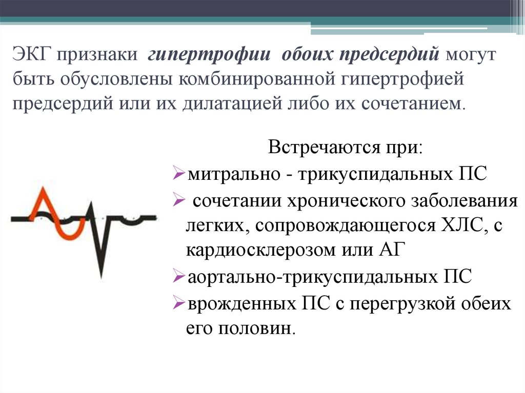 Гипертрофия на экг. Признаки гипертрофии обоих предсердий на ЭКГ. Перегрузка левого и правого предсердия на ЭКГ это что. Комбинированная гипертрофия желудочков на ЭКГ. ЭКГ при гипертрофии обоих предсердий.