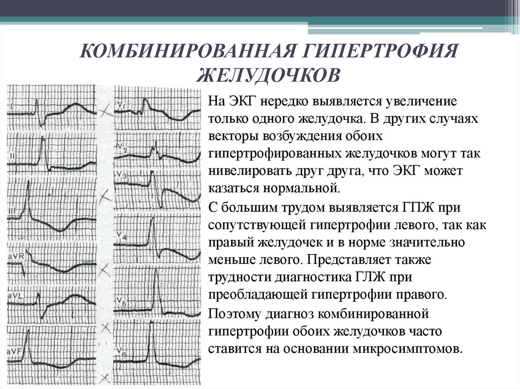 Гипертрофия левого желудочка экг фото