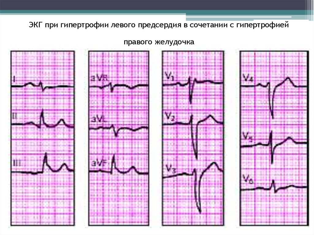 Гипертрофия правого предсердия. ЭКГ при гипертрофии левого правого желудочка. Гипертрофия правого желудочка на ЭКГ. P pulmonale гипертрофия правого желудочка. Гипертрофия правых отделов сердца на ЭКГ.