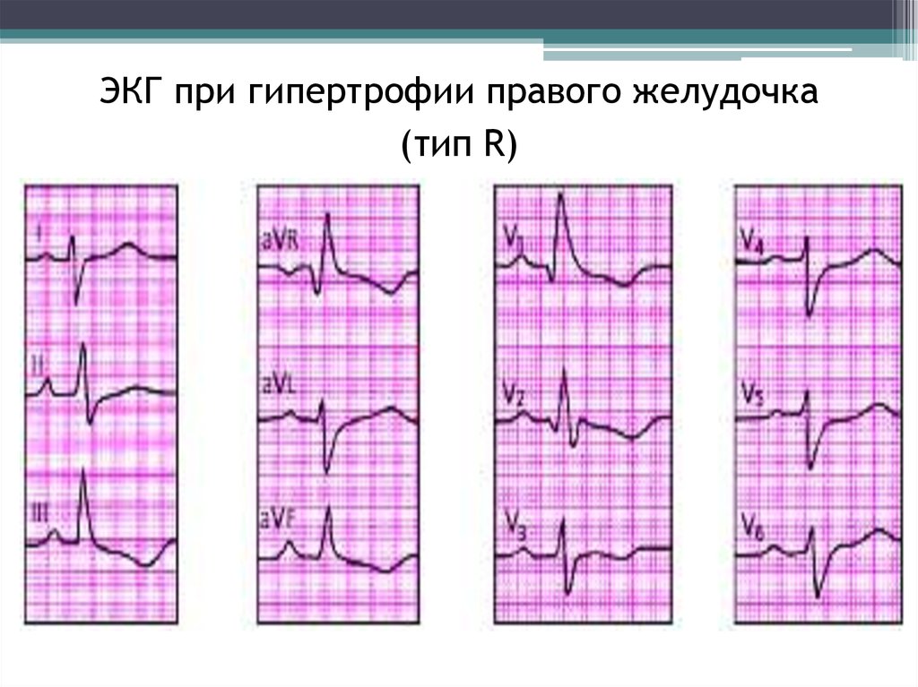 Гипертрофия лев желудочка экг. ЭКГ при гипертрофии левого правого желудочка. Гипертрофия правого желудочка r Тип на ЭКГ. ЭКГ при гипертрофии предсердий и желудочков. Гипертрофия правого желудочка сердца на ЭКГ.