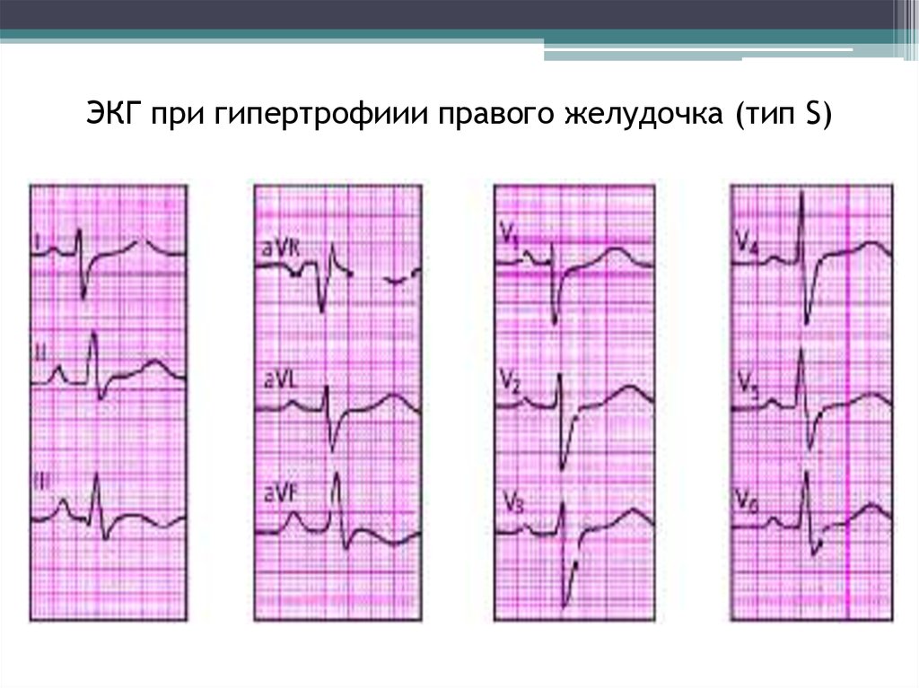 Гипертрофия правого желудочка на экг. Типы гипертрофии правого желудочка на ЭКГ. S Тип гипертрофии правого желудочка. S Тип гипертрофии правого желудочка на ЭКГ. ЭКГ при гипертрофии левого желудочка и ХОБЛ.
