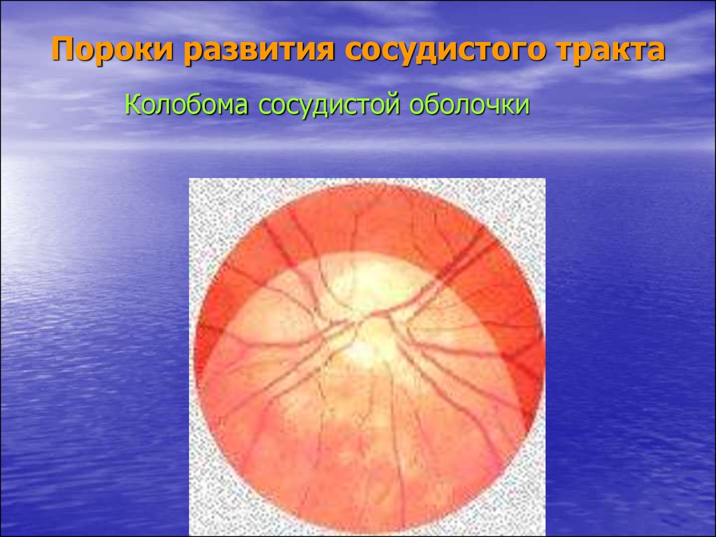 Заболевания сосудистой оболочки. Колобома зрительного нерва. Колобома собственно сосудистой оболочки.