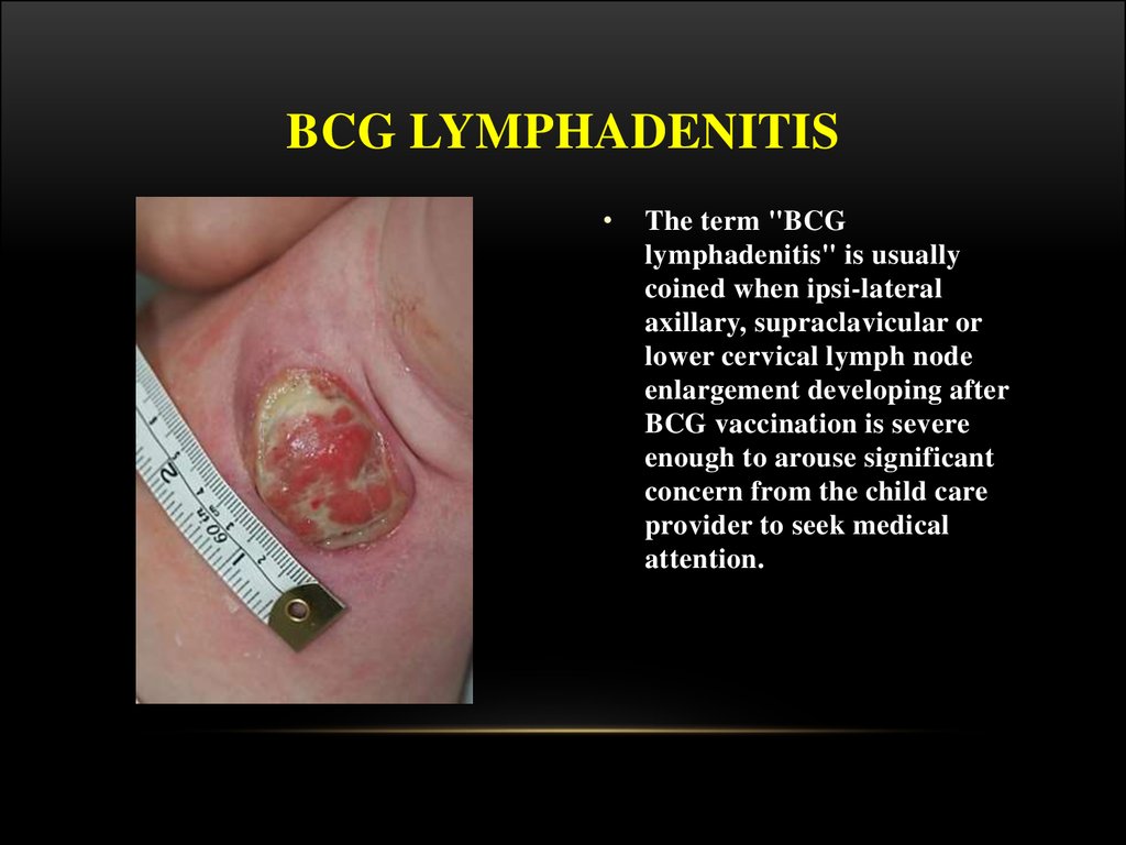 BCG LYMPHADENITIS