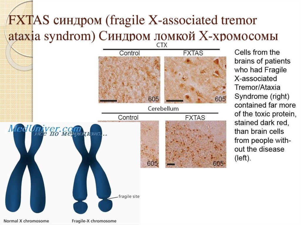 FXTAS синдром (fragile X-associated tremor ataxia syndrom) Синдром ломкой Х-хромосомы