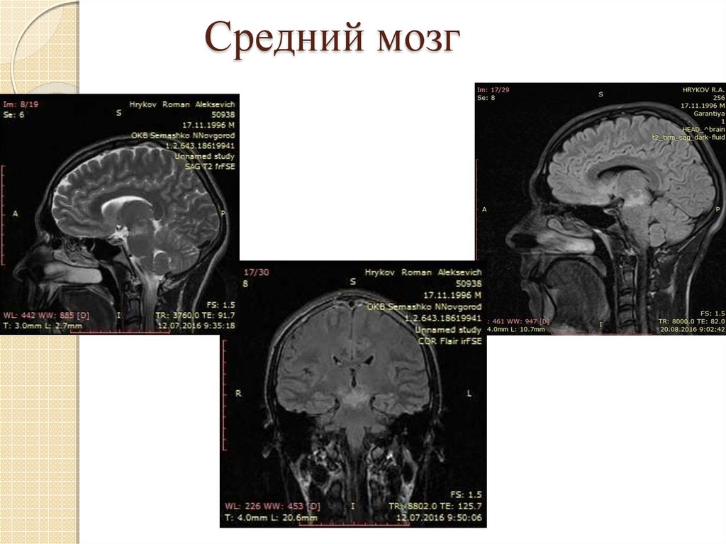 Поражение ствола. Опухоль среднего мозга. Поражение среднего мозга. Средний мозг на кт.