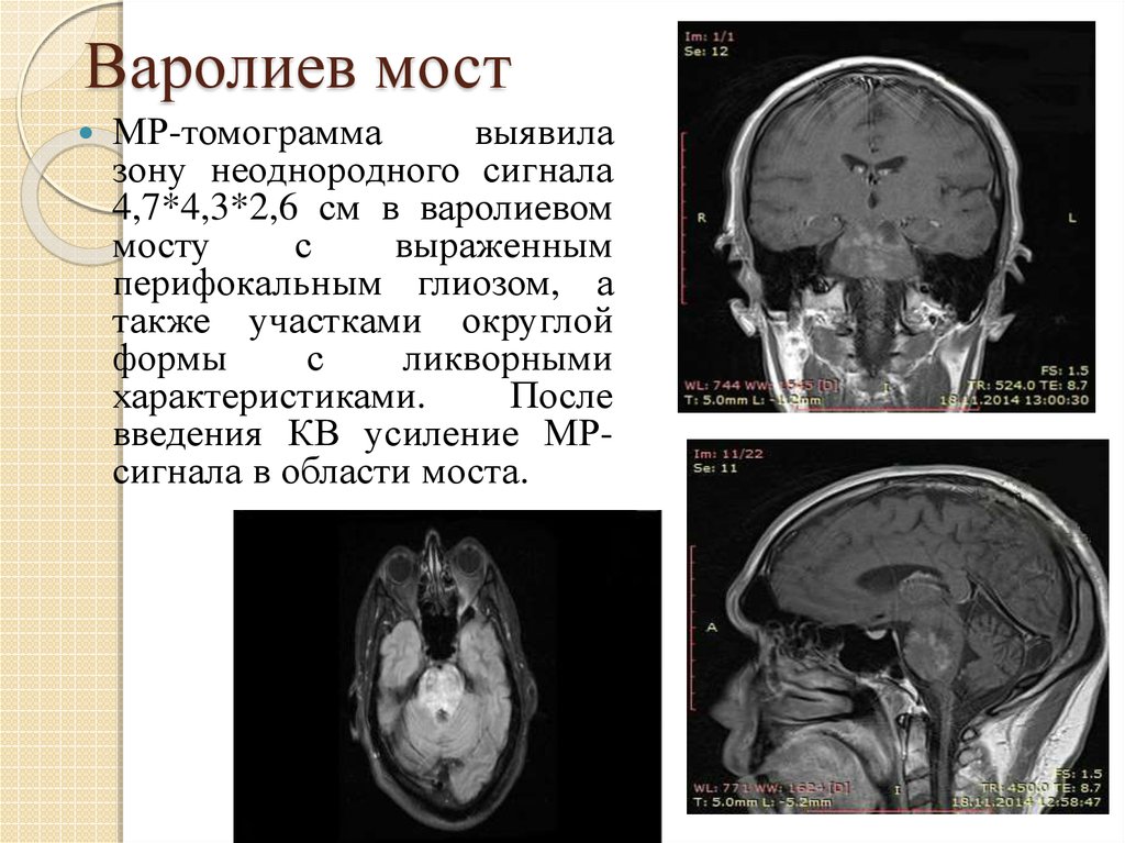 Поражение ствола. Симптомы поражения варолиева моста. Опухоль варолиева моста. Варолиев мост мрт. Поражение варолиева моста на кт.