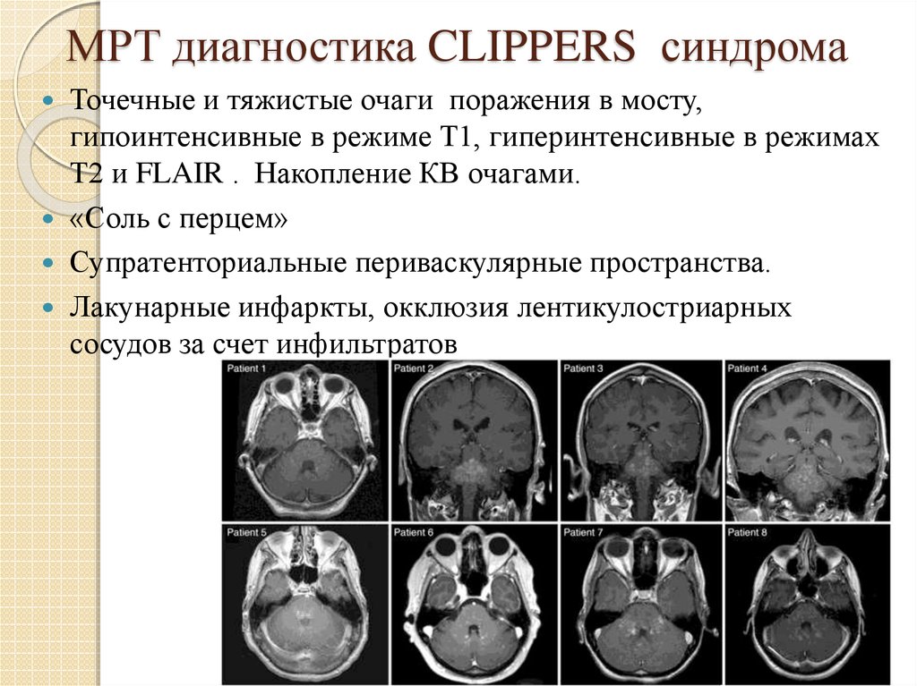 МРТ диагностика CLIPPERS синдрома