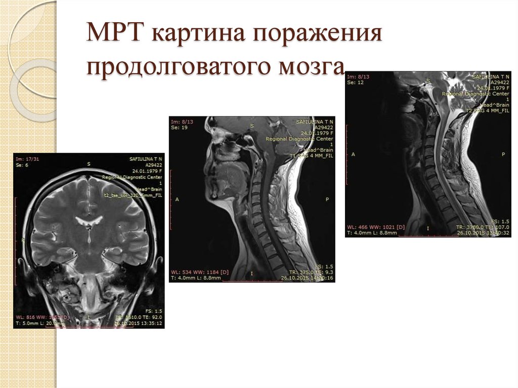 МРТ картина поражения продолговатого мозга