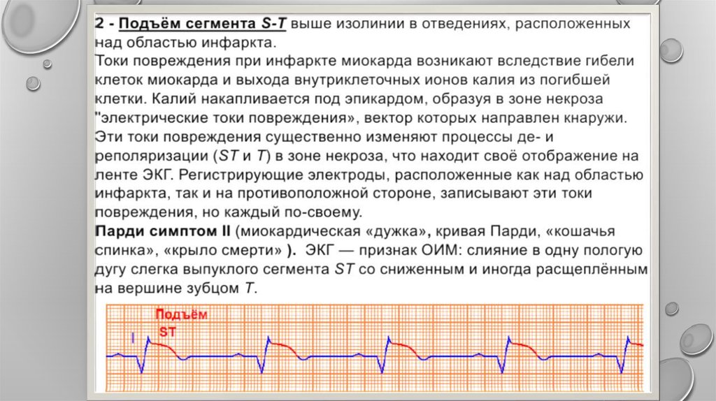 Подъем st. Подъем сегмента St на ЭКГ. Сегмент St на ЭКГ выше изолинии. Подъем сегмента St на ЭКГ при инфаркте. Подъем изолинии на ЭКГ.