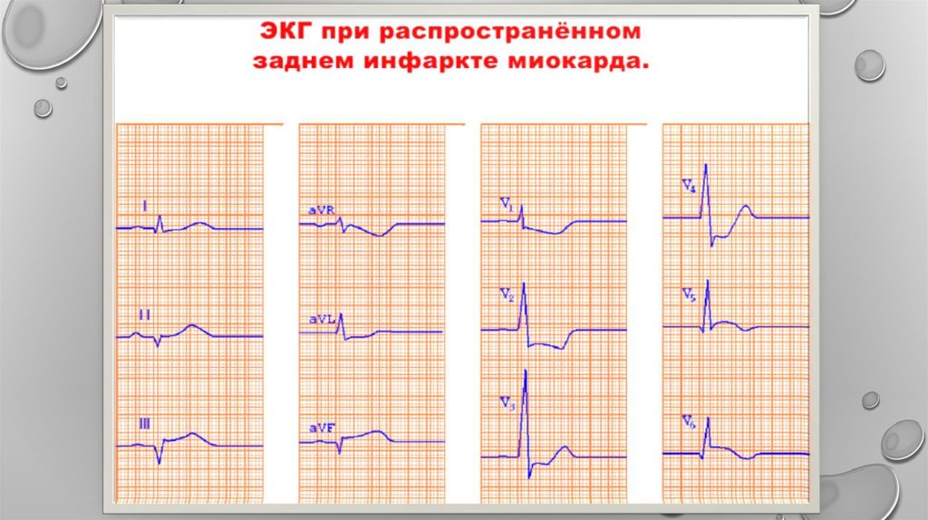 Экг без. ЭКГ при заднебоковом инфаркте. Распространенный задний инфаркт миокарда ЭКГ. Распространенный передний инфаркт миокарда на ЭКГ. ЭКГ при переднеперегородочном инфаркте миокарда.