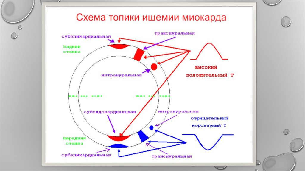 Субэндокардиальная ишемия передней стенки что это