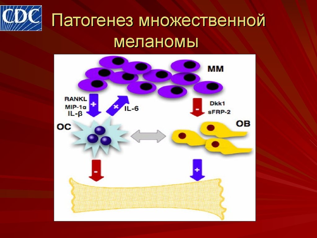 Патогенез множественной миеломы схема