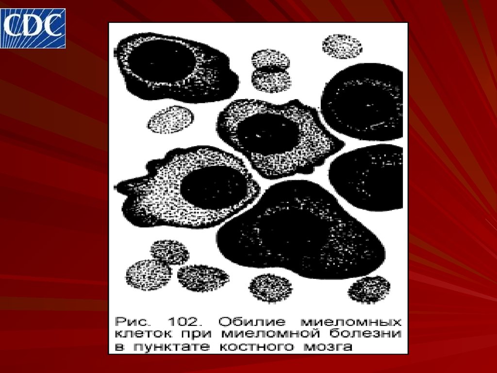 Патофизиология парапротеинемических лейкозов - презентация онлайн