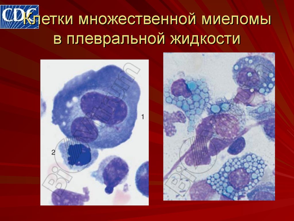 Лейкозы патофизиология презентация