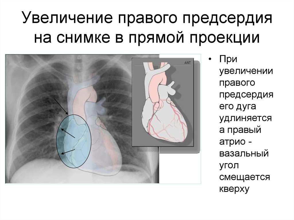 Увеличено правое. Гипертрофия левого желудочка рентген. Гипертрофия сердца на рентгене. Увеличение правых отделов сердца. Увеличение сердца на рентгене.