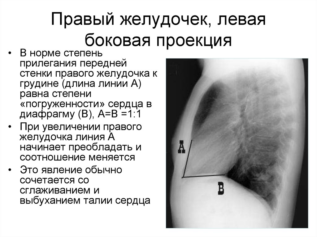 Увеличение правого. Правое легкое в боковой проекции. Левая боковая проекция рентген. Правая боковая проекция.